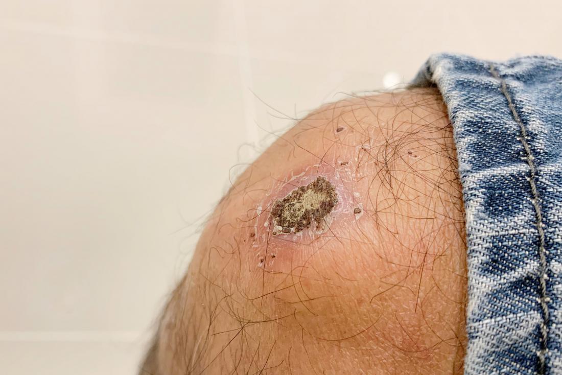 Does A Scab Mean Healing Debunking The No Marks Myth